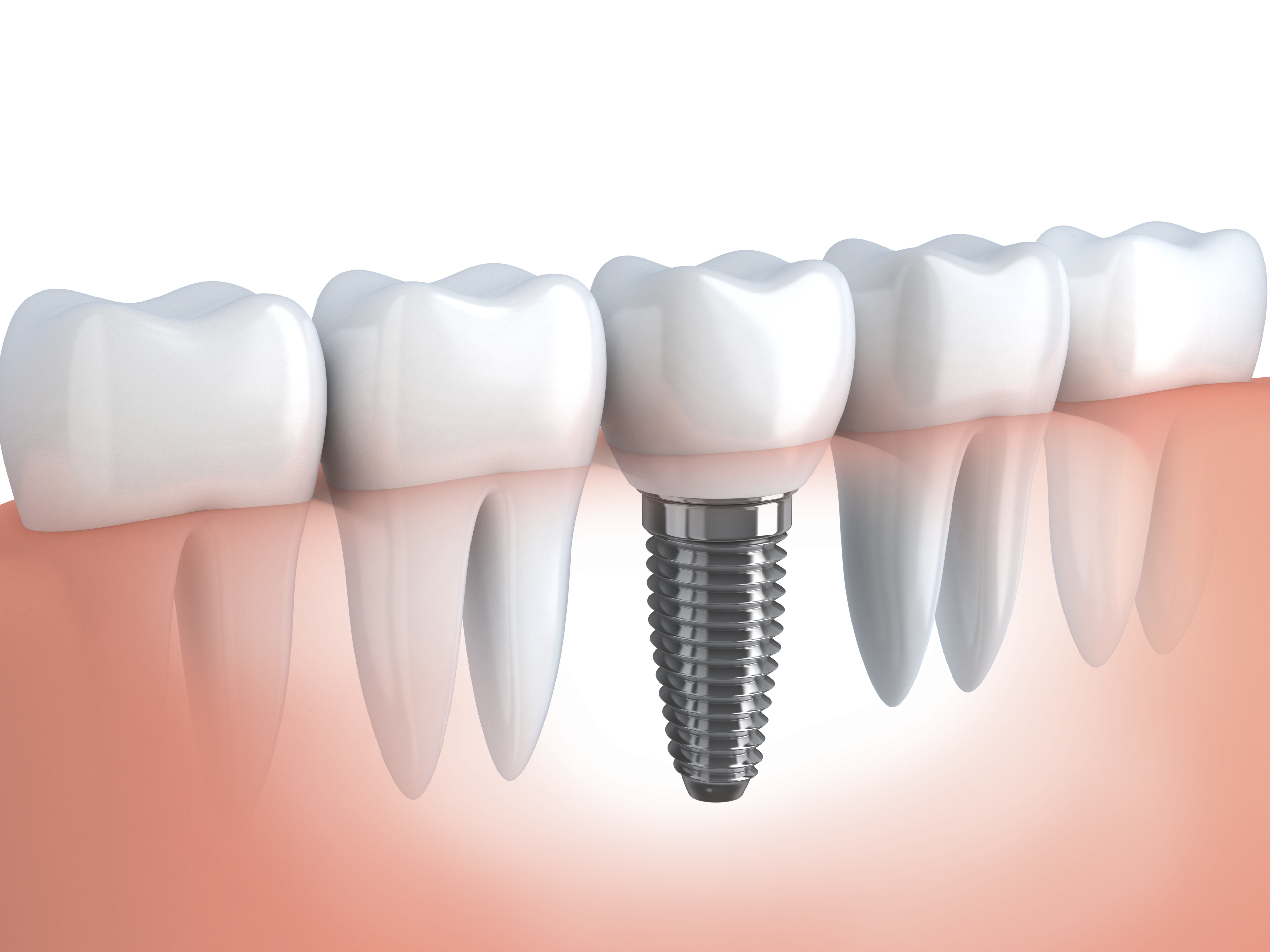 Dental Implant Procedure and Cost - Dr B Doherty