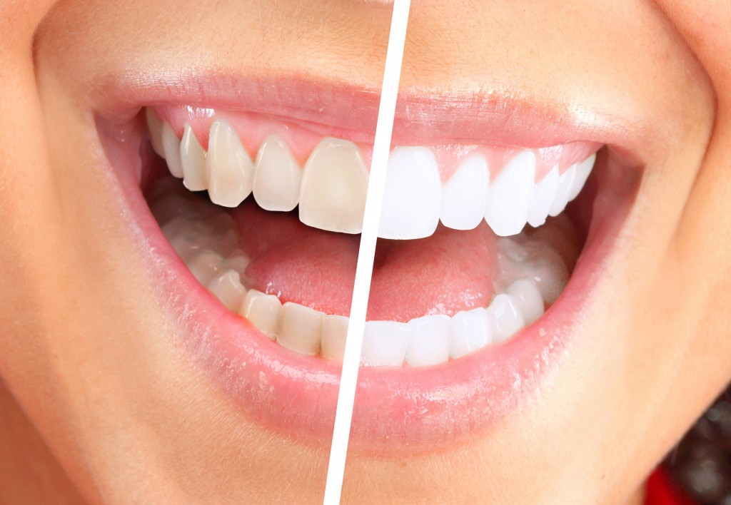 Teeth Whitening Procedure and Costs - Dr B Doherty