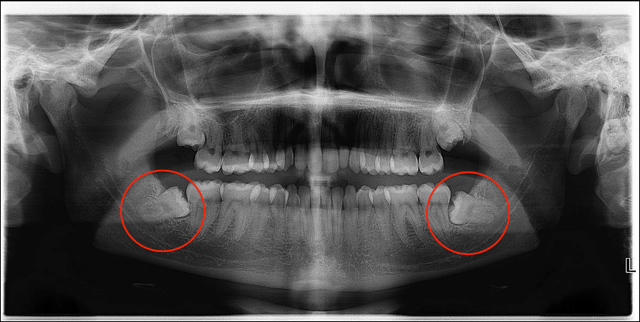 Wisdom teeth are the third molars (the eighth tooth) of our jaws 