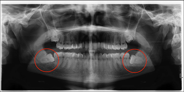 Wisdom teeth are the third molars (the eighth tooth) of our jaws